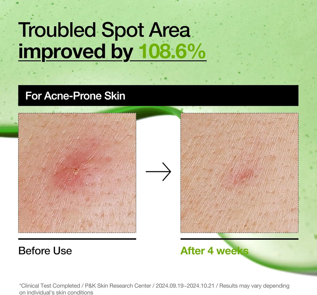 Anua Azelaic Acid 10 Hyaluron Redness Soothing Serum, (30ml/ 1.01 fl oz.)